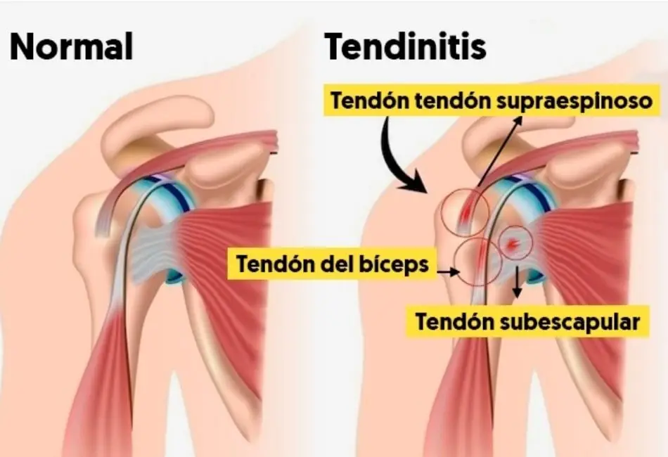 tendinitis hombro fisioterapia madrid