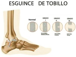 fisioterapia esguince tobillo madrid