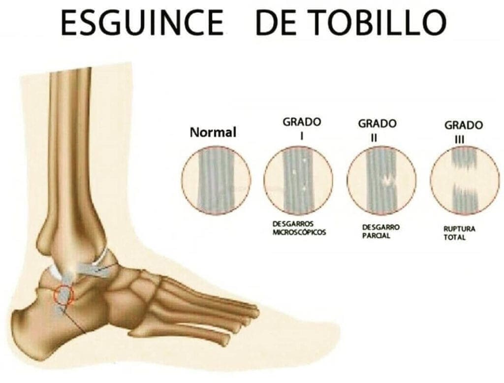 fisioterapia esguince tobillo madrid