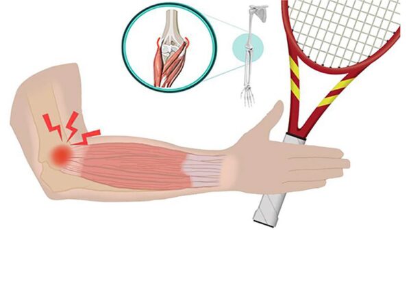 epicondilitis fisioterapia madrid padel
