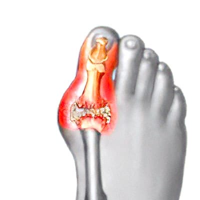 hallux rigidus fisioterapia