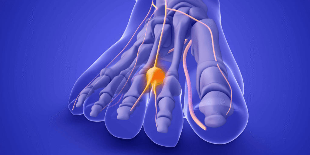 fisioterapia neuroma de morton madrid
