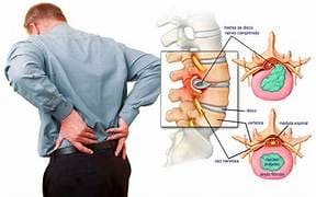 fisioterapia madrid lumbalgia
