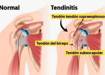 tendinitis hombro fisioterapia madrid